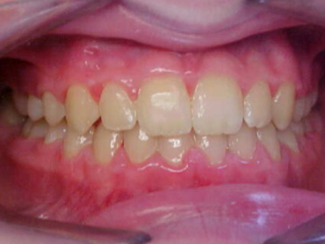 upper and lower fixed braces
