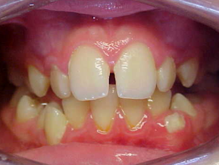 upper and lower fixed braces with extractions